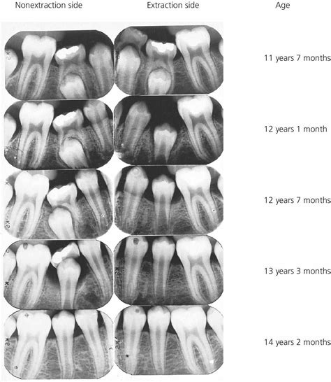 The Psychological Analysis of Shedding Deciduous Teeth