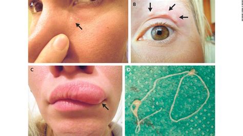 The Psychological Analysis of a Parasite on the Facial Area