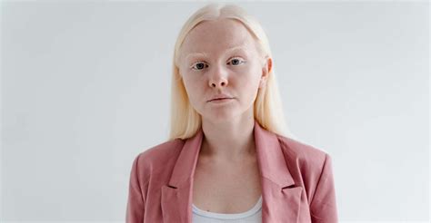 The Psychological Significance of Dreaming about a Child with Albinism