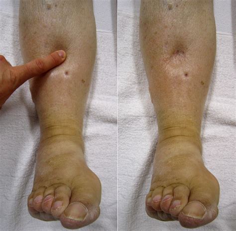 The Relationship Between Swollen Legs and Fluid Retention