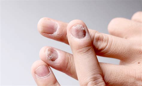 The Role of Anxiety and Stress in Nail Loss Experiences