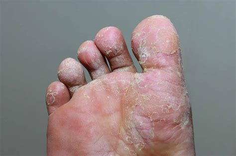 The Role of Fungi in Foot Infections