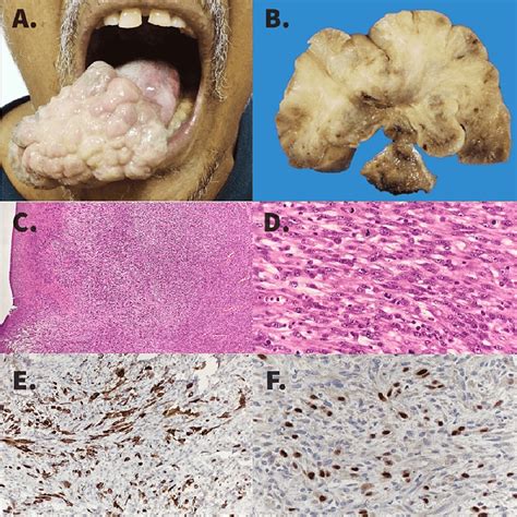 The Role of Genetics in Tongue Carcinoma