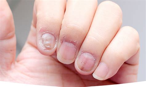 The Role of Hygiene in Preventing Nail Fungal Infections