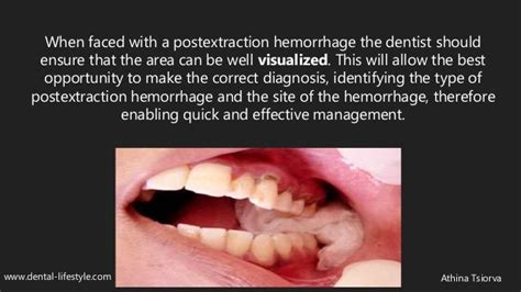 The Role of Physical Factors in Dreaming about Dental Hemorrhage