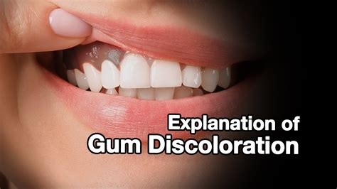 The Shadowed Aspect of Oral Health: Linking Gum Discoloration to Dental Diseases