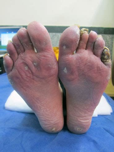 The Significance and Analysis of Foot Lesions in Dreams