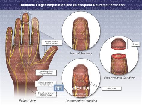 The Significance of Analyzing and Deciphering Finger Amputation Dreams