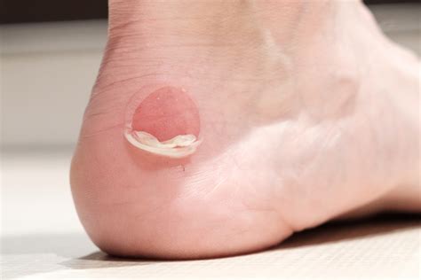The Significance of Foot Blisters in Dreams
