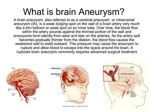 The Significance of Foreseeing in Dreams about Cerebral Aneurysms