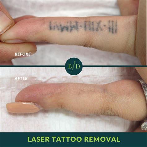 The Significance of Proper Post-tattoo Removal Care for Achieving Optimal Results