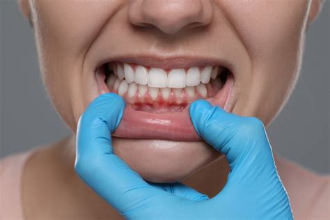 The Significance of Rubber Teeth in Maintaining Optimal Dental Well-being