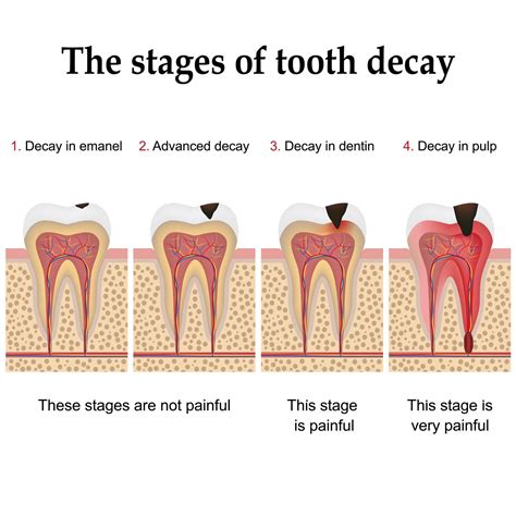 The Symbolic Meaning Behind Visions of Decayed Dental Structures