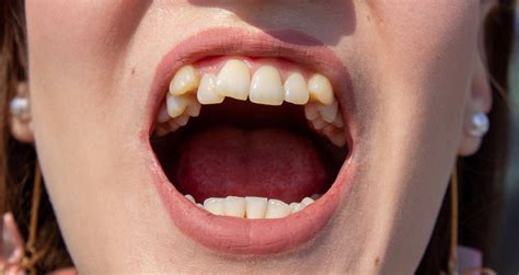 The Symbolic Meaning behind Dreams about Misaligned Teeth