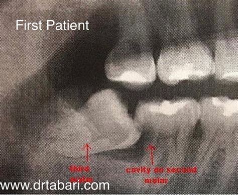 The Symbolic Meaning of Dreams Involving Damaged Third Molar Teeth