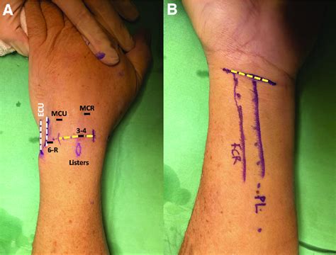 The Symbolic Meanings of Dreams related to Wrist Incisions