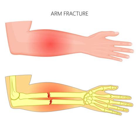 The Symbolic Significance of Arm Fracture in Dream Manifestations