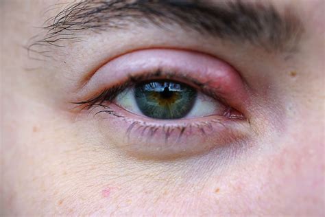 The Symbolic Significance of Experiencing a Stye within the Eye