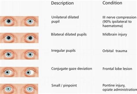 The Symbolic Significance of Losing Pupil