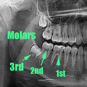 The Symbolic Significance of the Eruption of Third Molars in Dream Interpretation