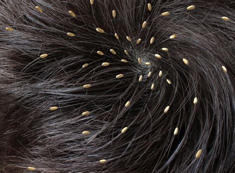 The Unexpected Link Between Dreams and Real-Life Lice Outbreaks