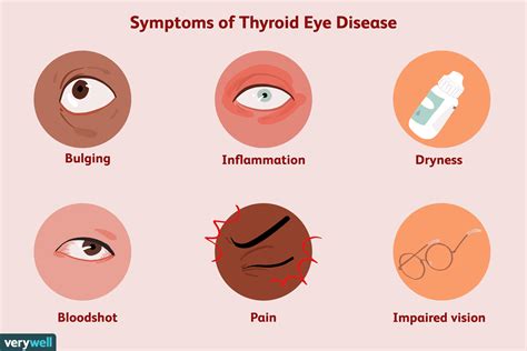 Thyroid Dysfunction and its Impact on Eye Appearance