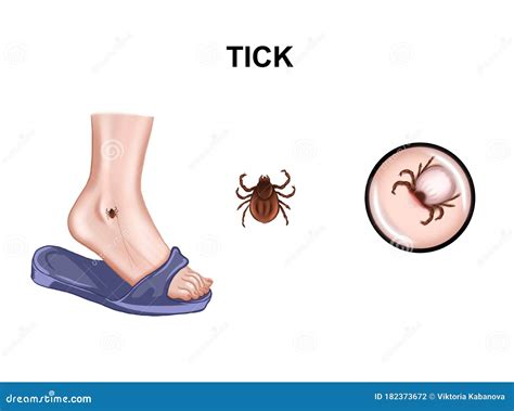 Tick Bites as a Representation of Physical and Emotional Infestation