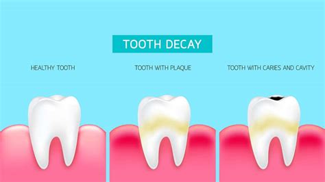 Tips for Dealing with Troubling Nighttime Visions of Tooth Decay and Loss