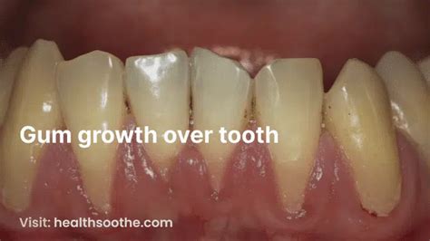 Tips for Understanding and Analyzing Dreams about the Growth of Gums over the Teeth