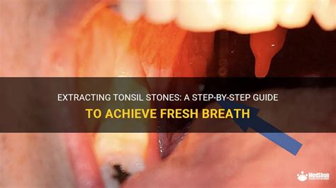 Tonsil Stones: Best Ways to Achieve Fresh Breath