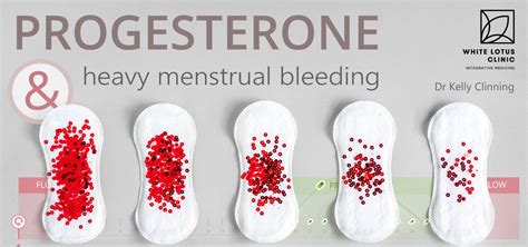 Treatment Options for Excessive Menstrual Flow