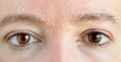 Troublesome Eyebrows: Understanding the Factors and Seeking Remedies