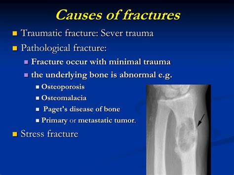 Underlying Factors Behind Retainer Fracture