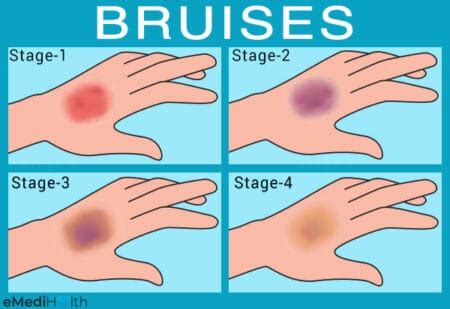 Understand Your Emotional Well-being through Bruised Fingers