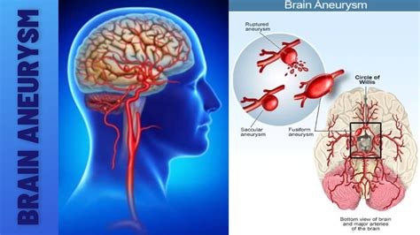 Understanding Brain Aneurysms and Their Manifestation in Dreams