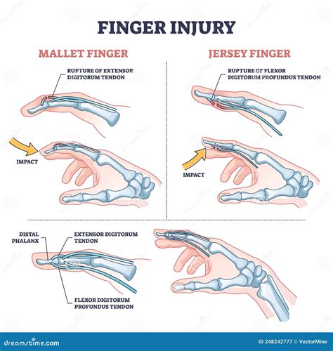 Understanding Common Emotional Responses to Dreams of Hand Injuries