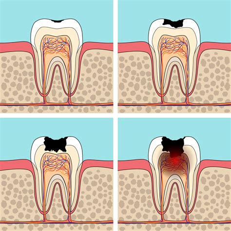 Understanding Dental Decay: A Brief Overview