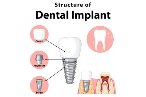 Understanding Dental Implants: Essential Information