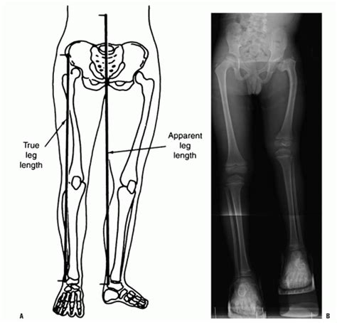 Understanding Differences in Leg Lengths