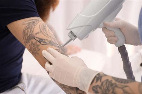 Understanding Different Tattoo Removal Methods