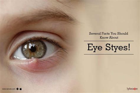 Understanding Eye Styes: Key Information You Should Be Aware Of