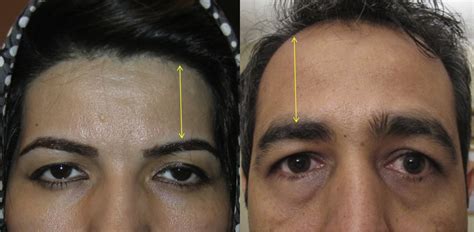 Understanding Eyebrow Asymmetry: What Leads to this Phenomenon?