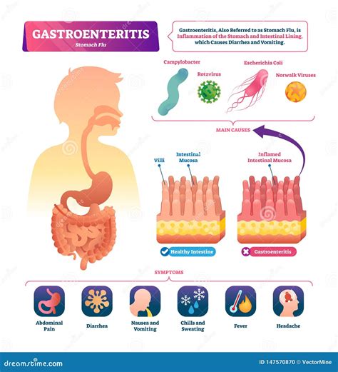 Understanding Gastrointestinal Infections: Triggers and Manifestations