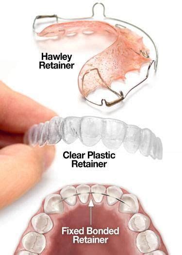 Understanding Retainers: Their Function and Mechanism