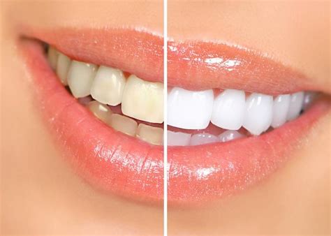 Understanding Teeth Discoloration: Common Causes and Types