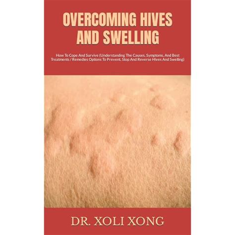 Understanding the Cause, Symptoms, and Management of Hives