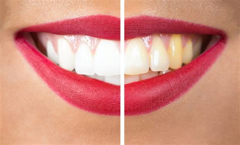 Understanding the Causes and Remedies for Discolored Teeth