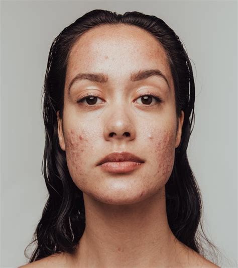 Understanding the Causes and Triggers of Acne