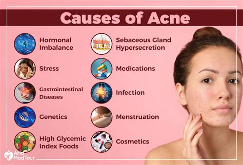 Understanding the Causes of Acne Breakouts