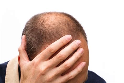 Understanding the Emotional Impact of Balding Nightmares